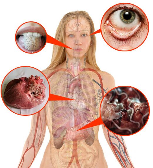 Parasites and worms in the human body. 